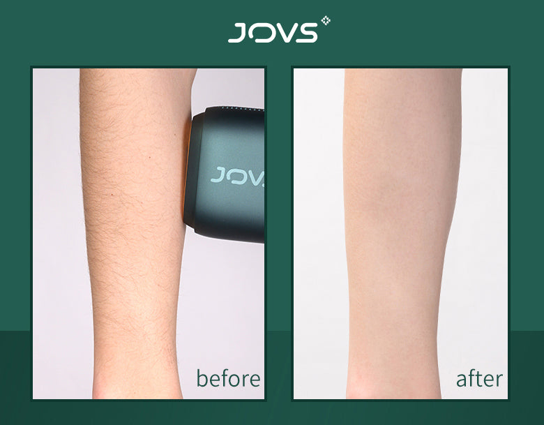 JOVS Venus Pro™ IPL(Intense Pulsed Light) Hair Remover
