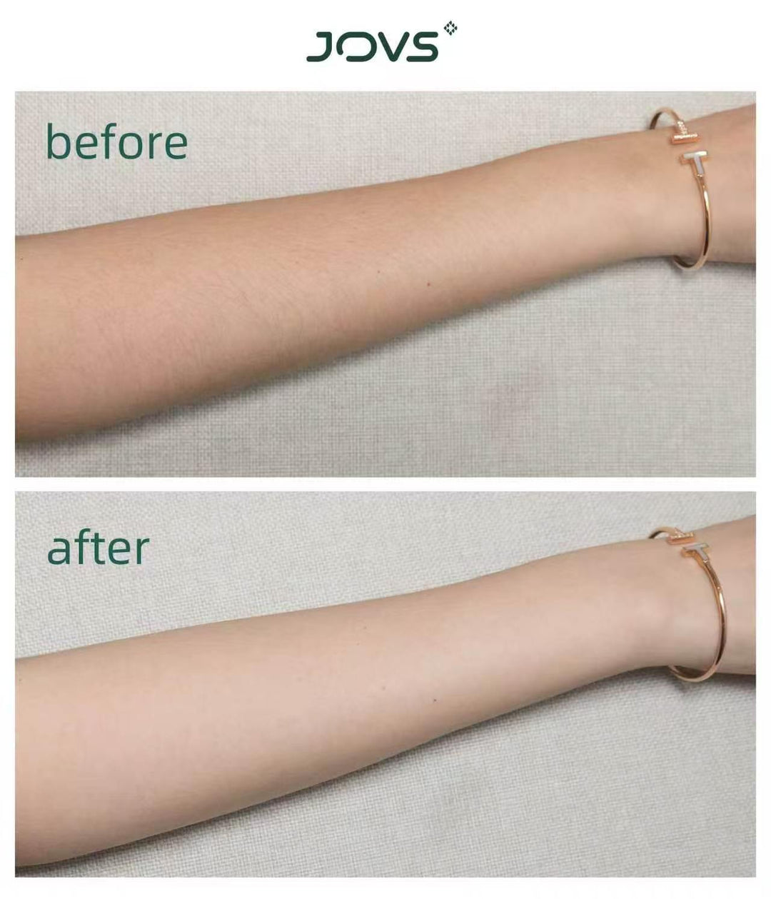 JOVS Venus Pro™ IPL(Intense Pulsed Light) Hair Remover